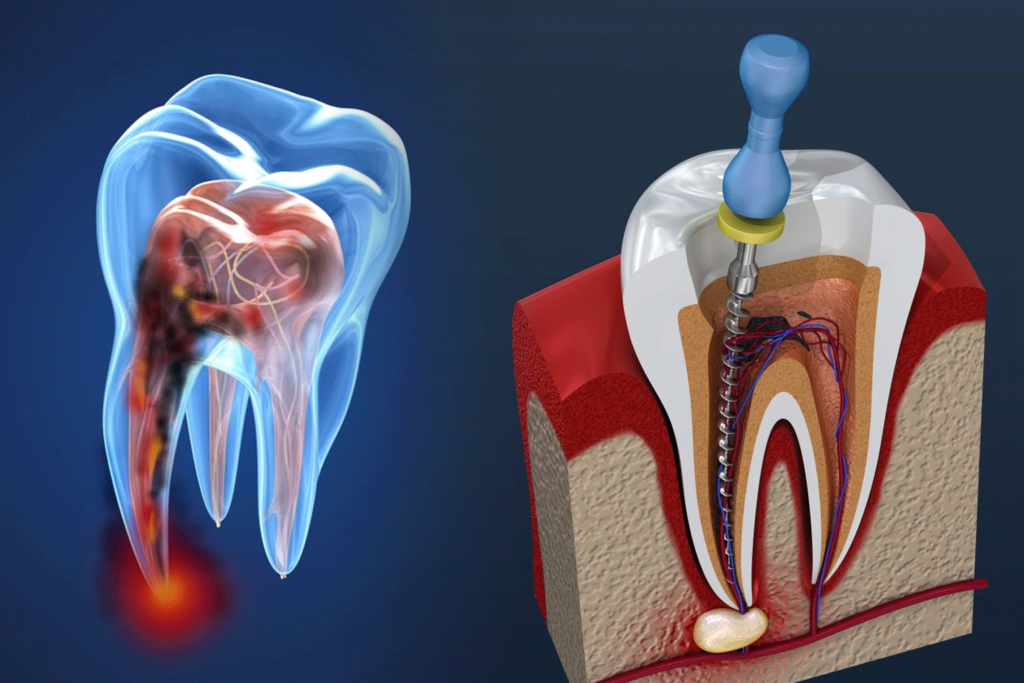 Tratamiento De Nervio Endodoncia