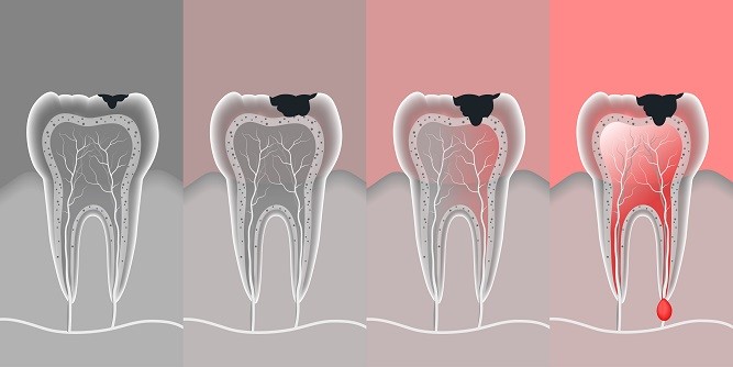 Caries-dental