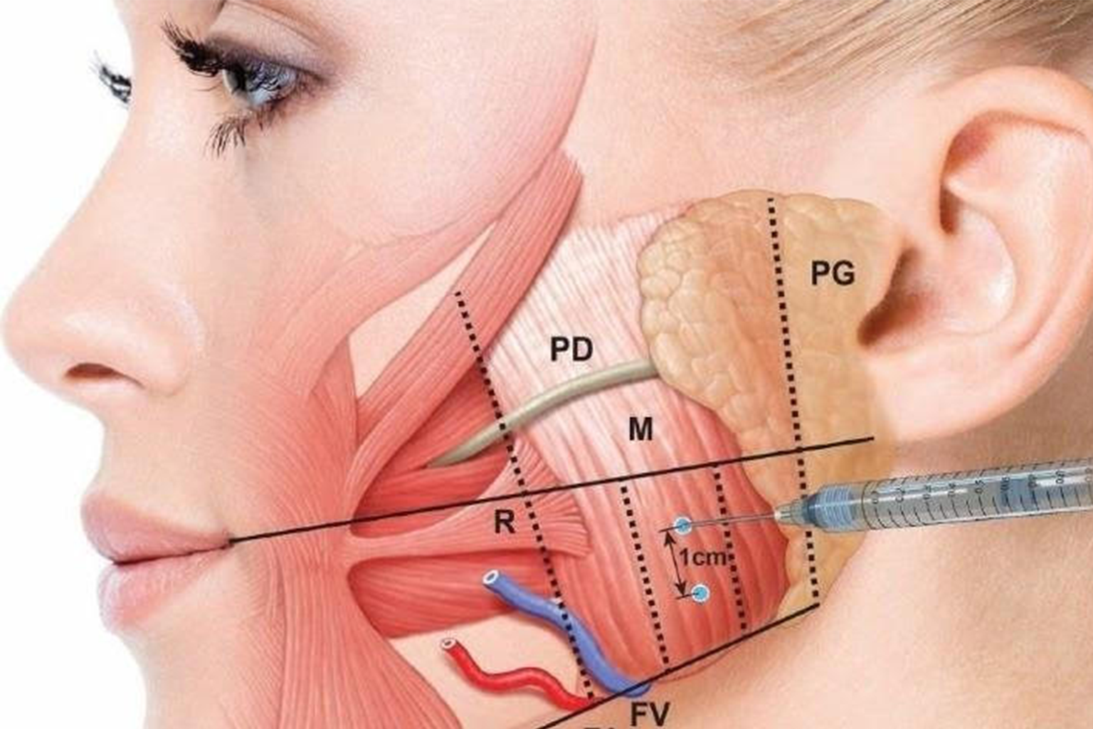 NovodentCR-Colocación-de-Botox