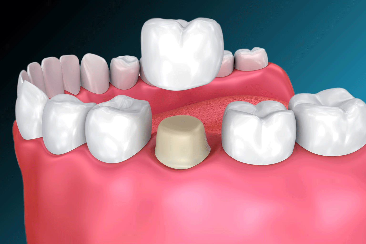 NovodentCR-Coronas-de-porcelana