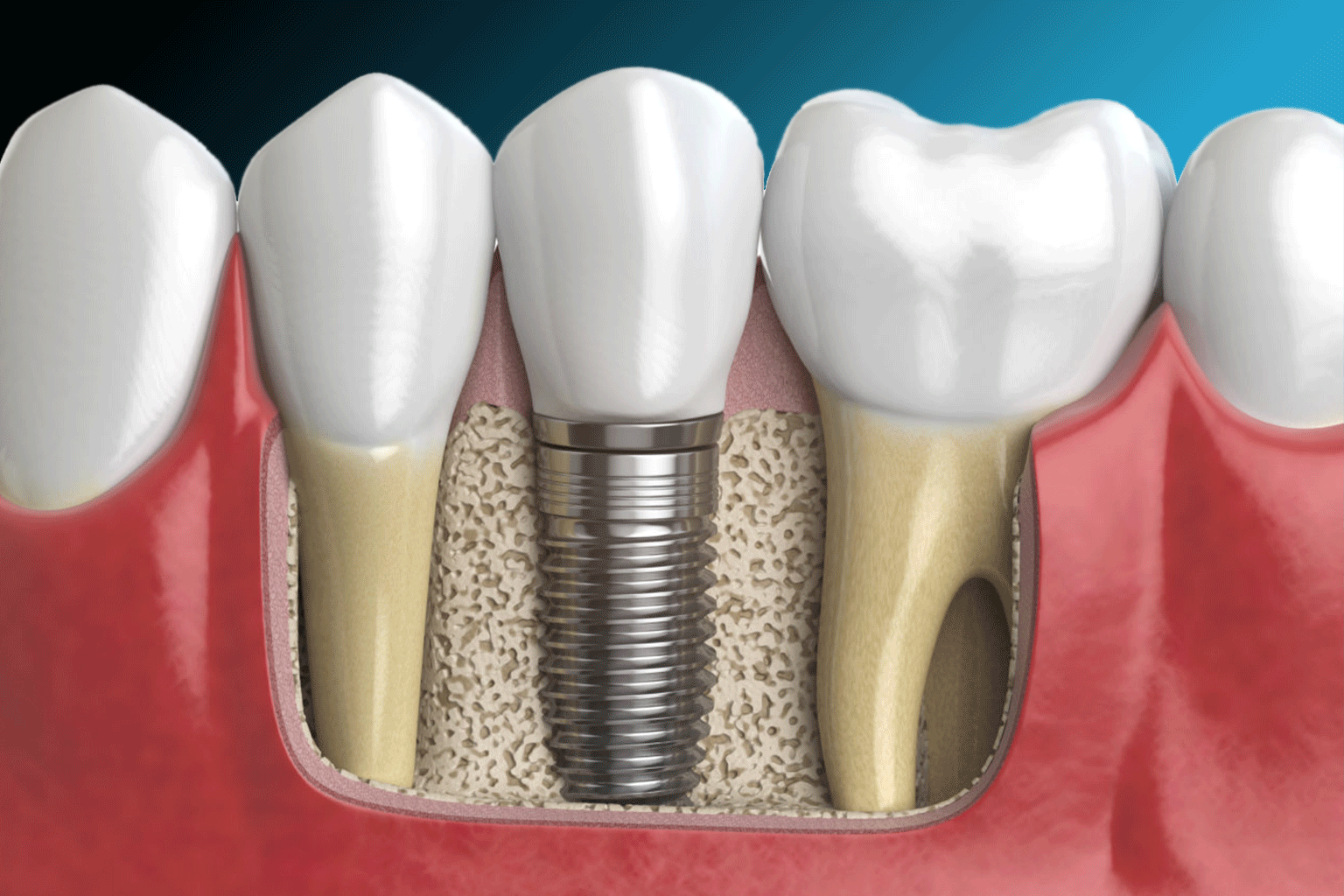 NovodentCR-Implantes-Dentales