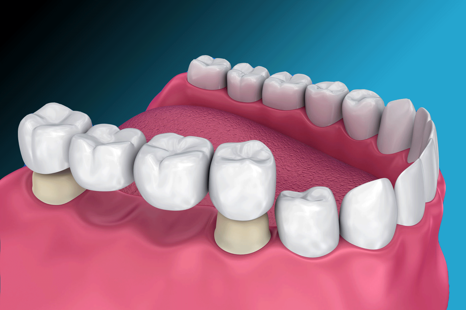 NovodentCR-Puentes-Dentales-Zirconio-o-Porcelana