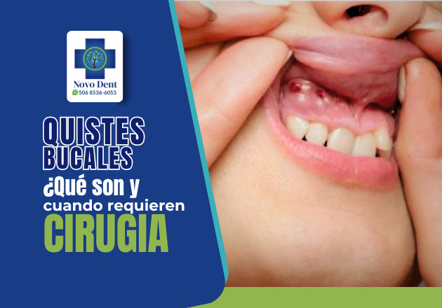 Quistes bucales qué son y cuándo requieren cirugía